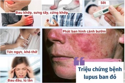 Lupus ban đỏ - Kiểm soát sớm bệnh lupus ban đỏ giúp ngăn ngừa biến chứng